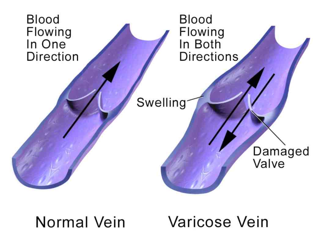 varisoce veins v normal veins